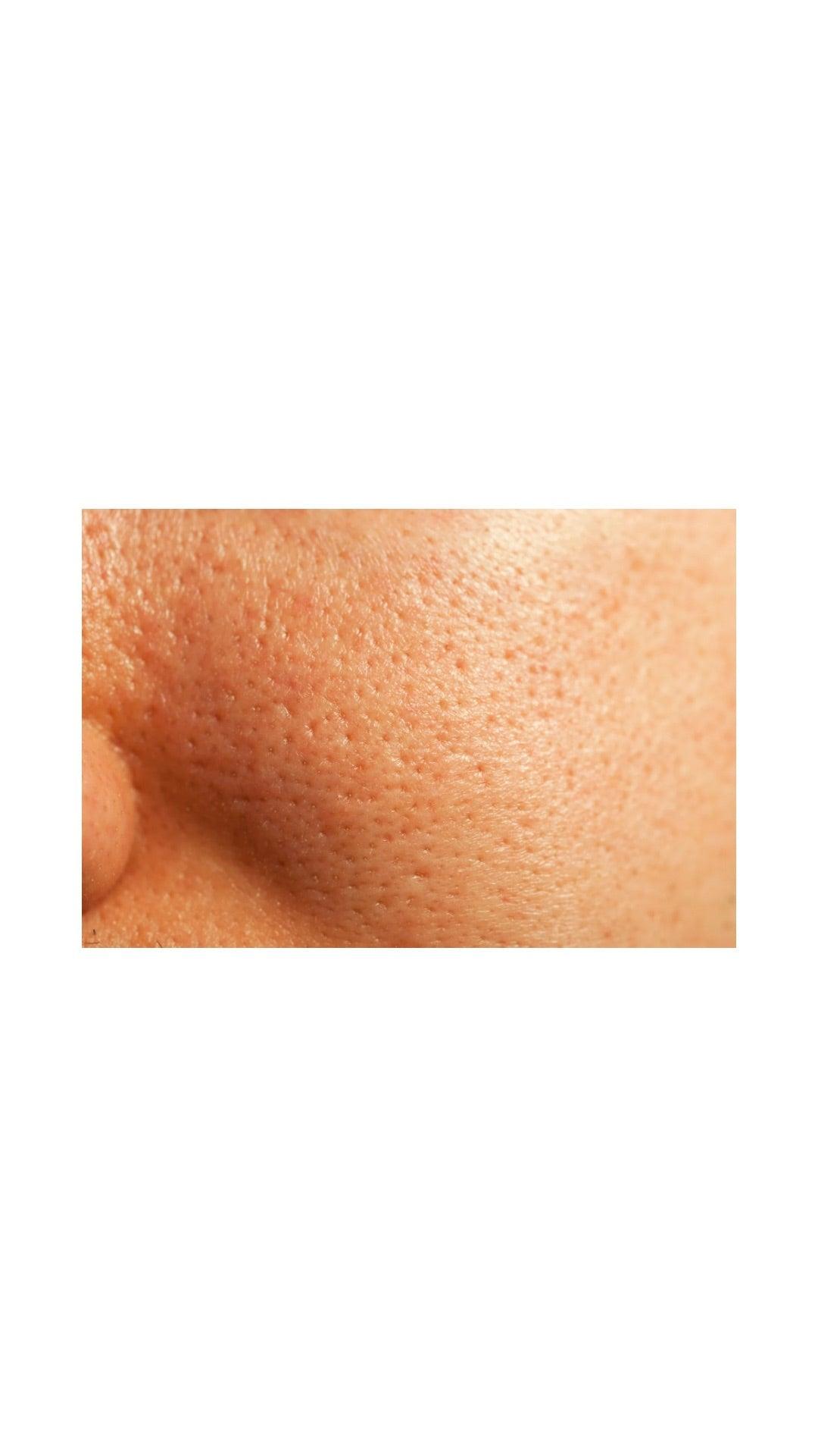 Enlarged Skin Pores: Causes, Treatment, and Prevention - Wild Life Millions